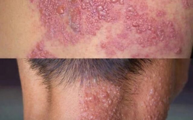 This Painful Blistering Rash Can Appear Suddenly — But It’s Not Caused by Who You Sleep Beside