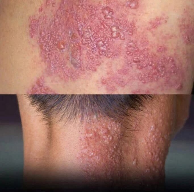 This Painful Blistering Rash Can Appear Suddenly — But It’s Not Caused by Who You Sleep Beside