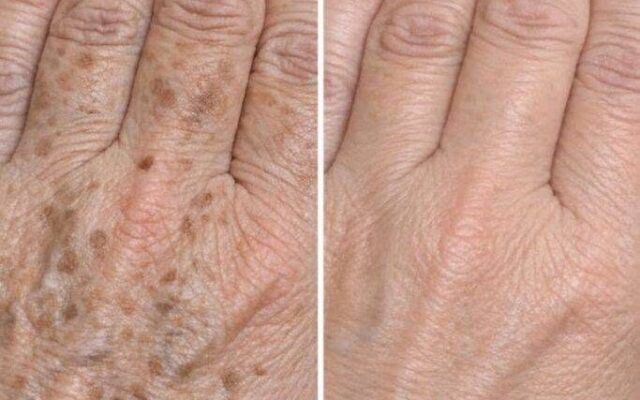 Can You Really Fade Dark Age Spots on Your Hands in Just 3 Minutes? Here’s What Actually Works